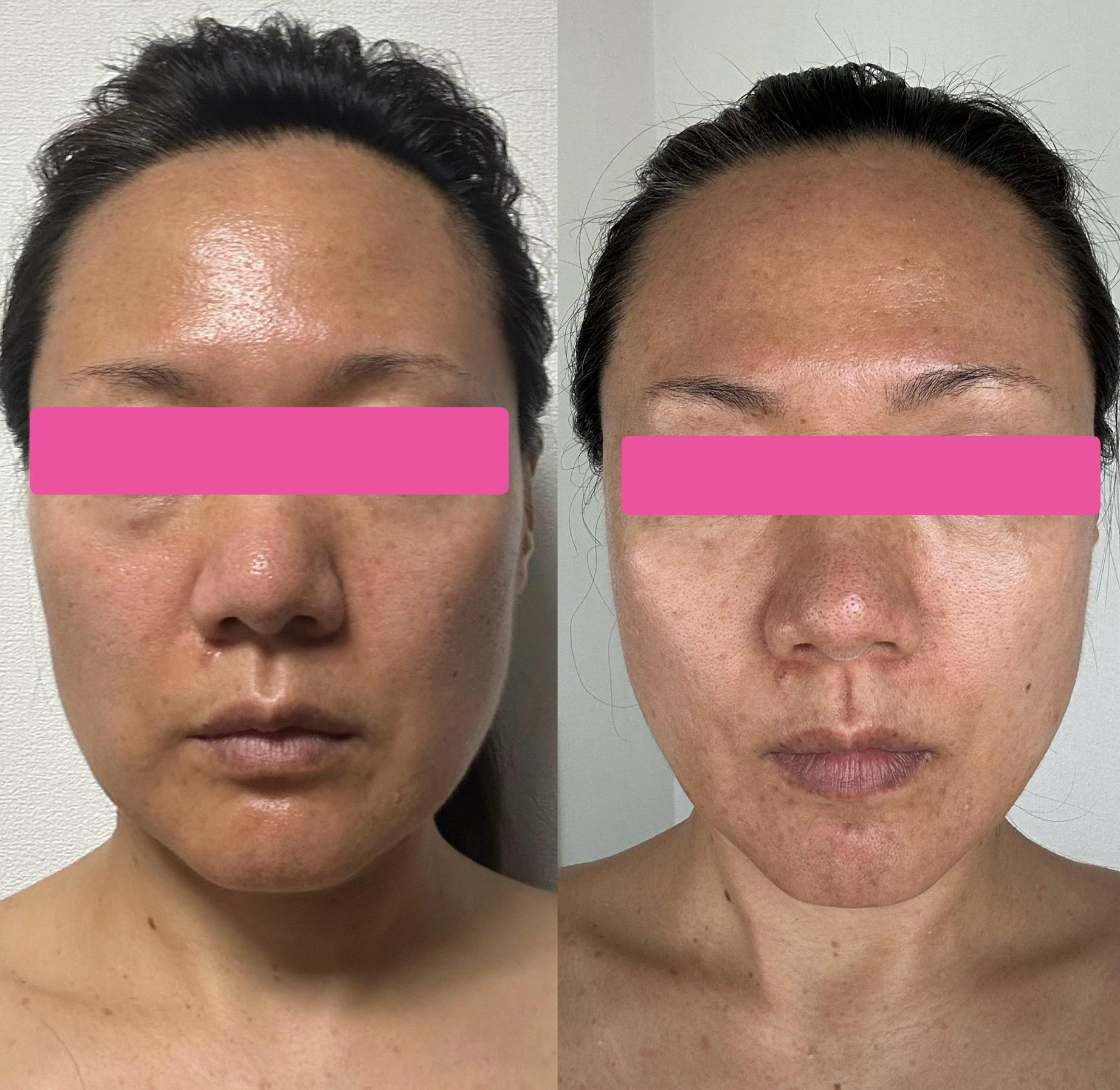 素肌再生術のビフォア・アフター 鼻