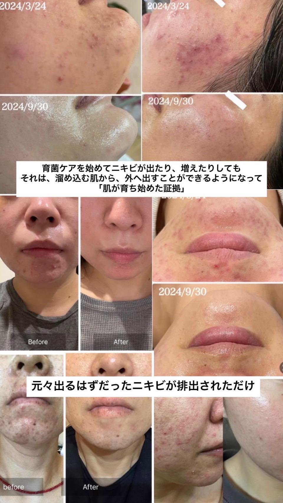肌質改善ケア Zoom 30分の商品画像