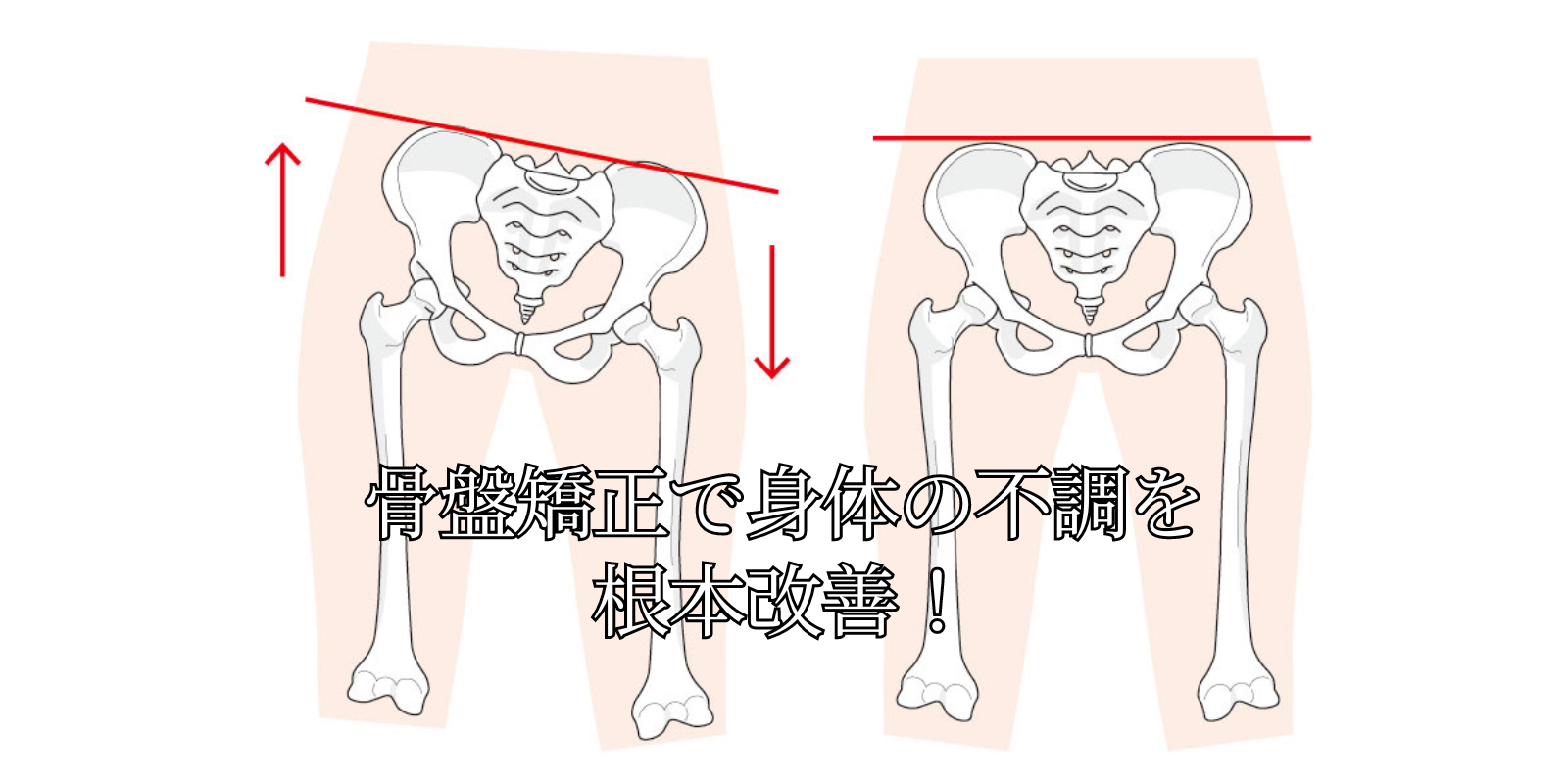 骨盤が歪むと腰痛や肩こりなど不調が起こる