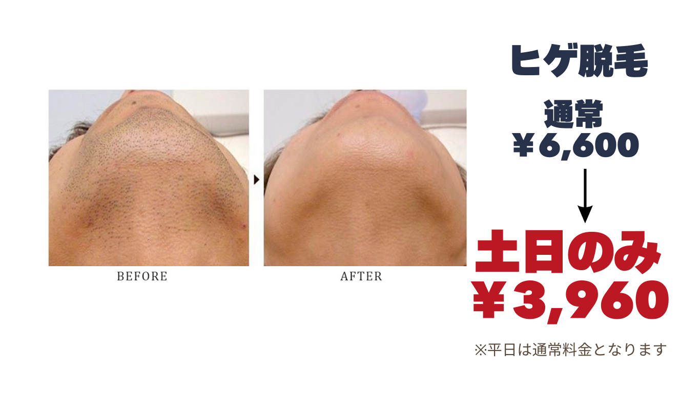 ヒゲ脱毛通常￥6,600　→土日のみ￥3,960