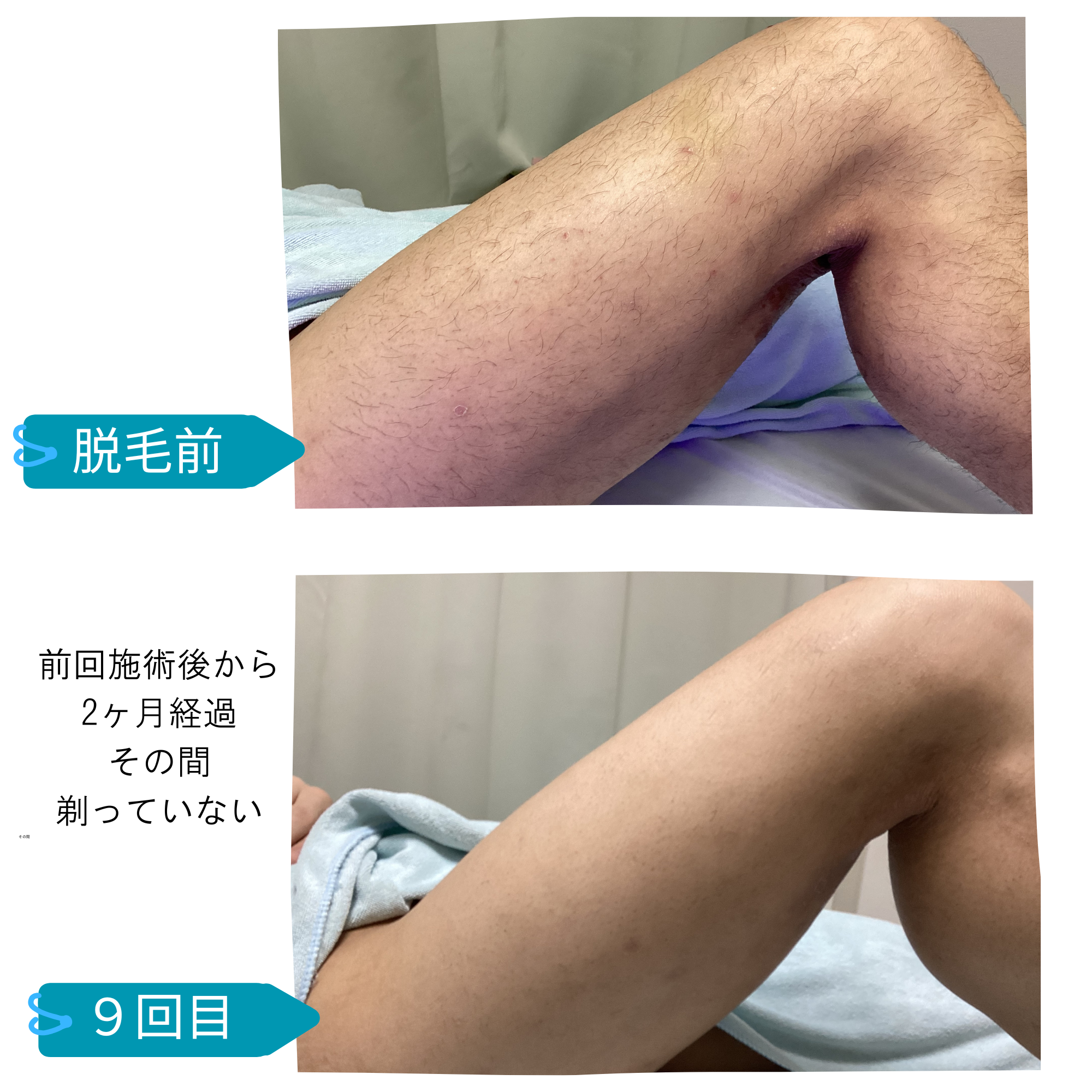 メンズ　全身脱毛　ビフォーアフター　30代男性　枚方　脱毛サロンきらり