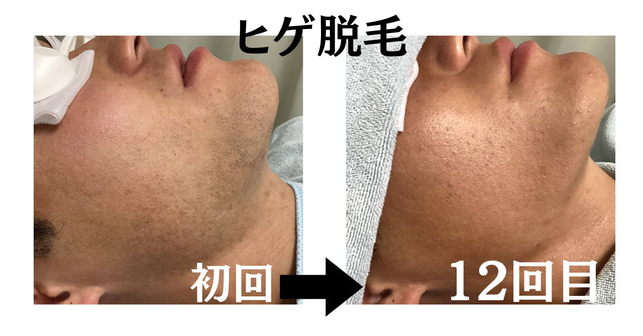 ひげ脱毛の効果が出るまでの回数を解説するイメージ画像