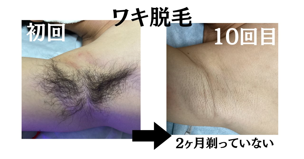 ワキ脱毛¥500キャンペーンを紹介するイメージ画像