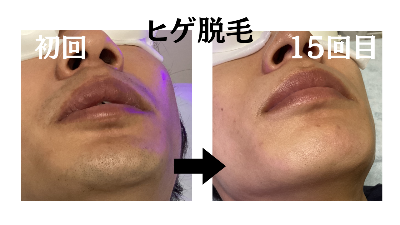 ヒゲ脱毛15回のビフォーアフターを紹介するイメージ画像