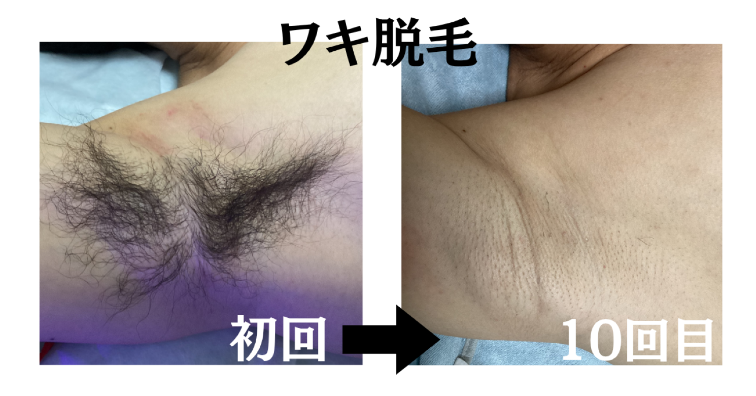 ワキ脱毛10回のビフォーアフターを紹介するイメージ画像