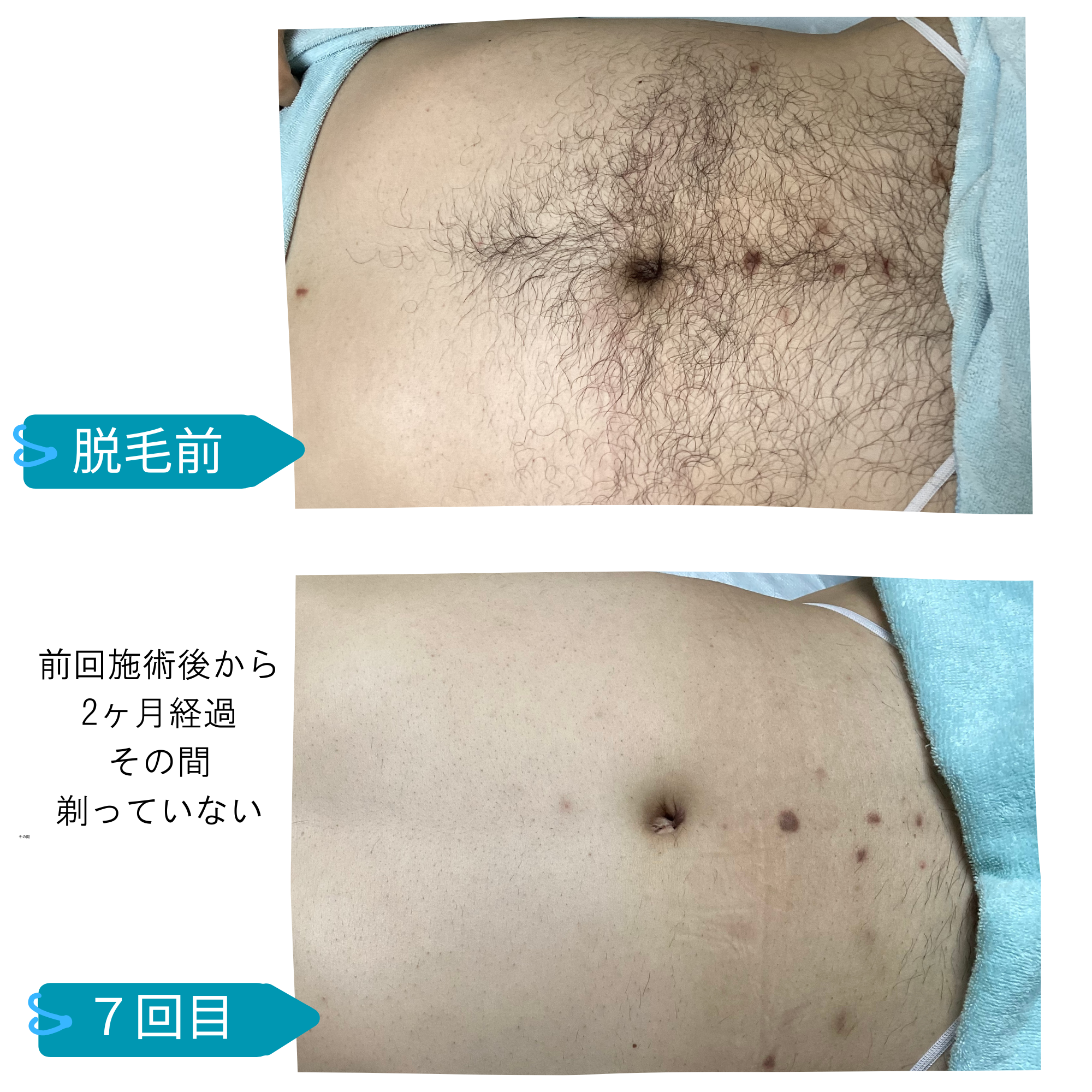 メンズ　全身脱毛　ビフォーアフター　40代男性　枚方　脱毛サロンきらり