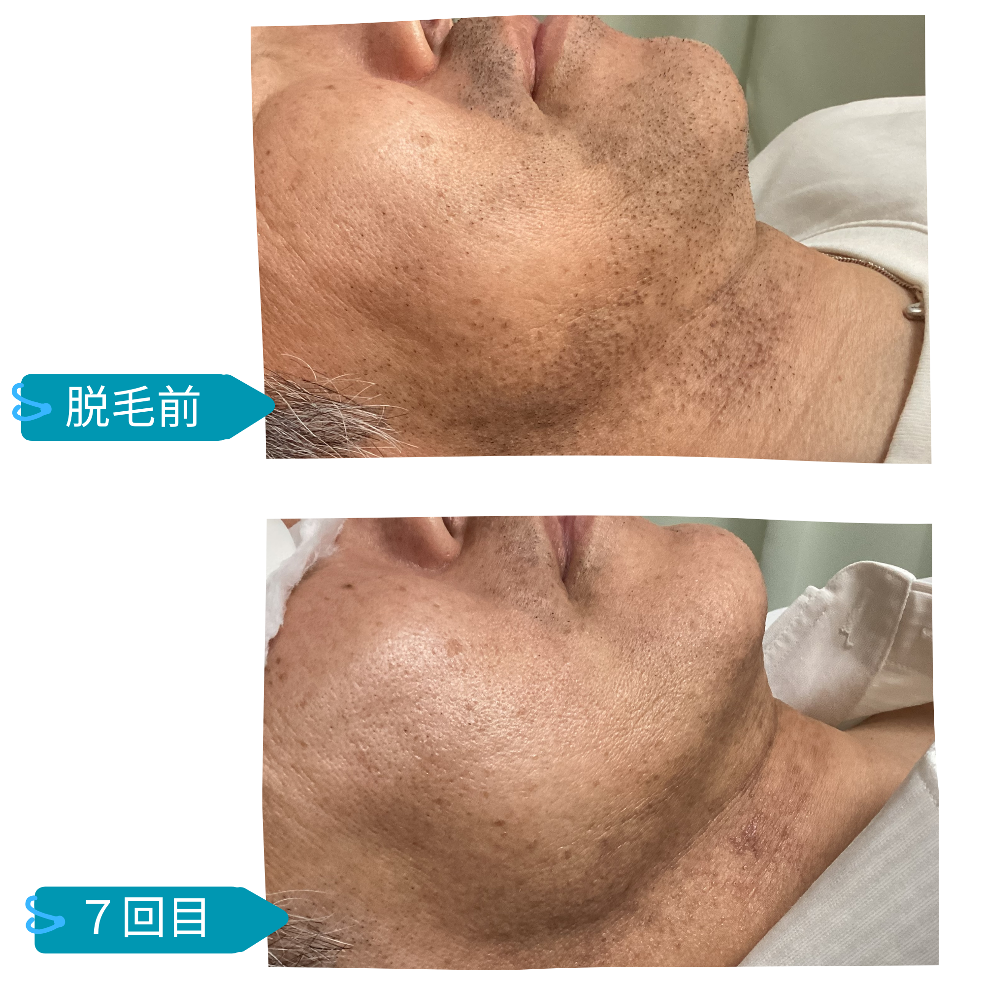 メンズヒゲ脱毛　ビフォーアフター　50代男性　枚方　脱毛サロンきらり