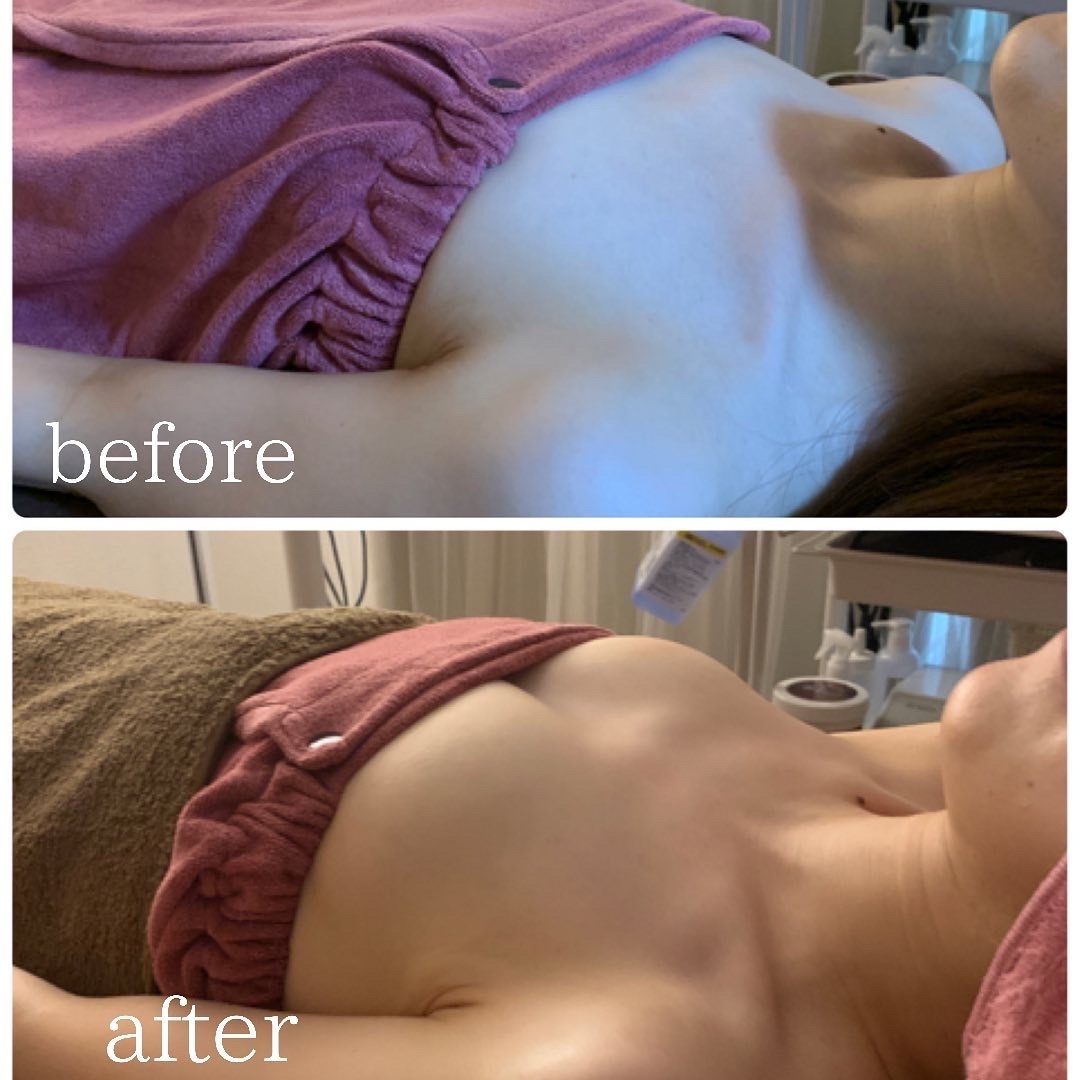 Before/After