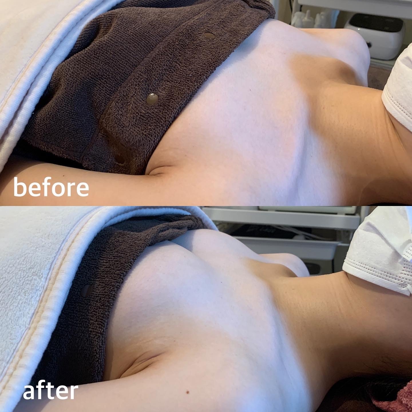 Before/After