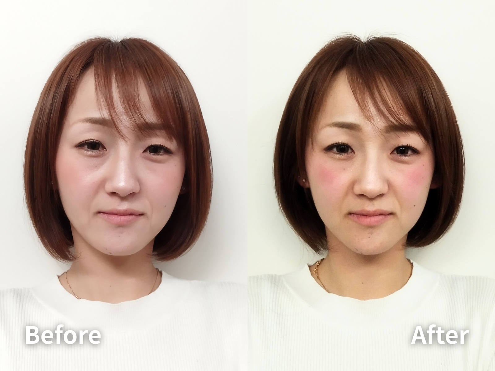 小顔矯正before＆after