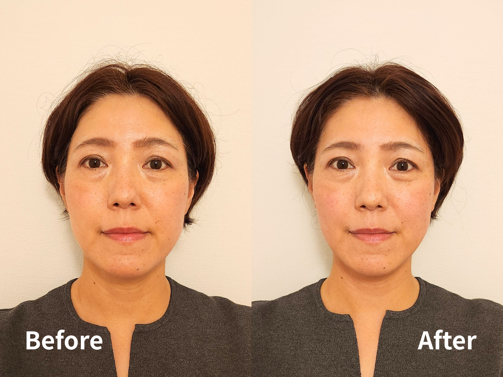 小顔矯正before＆after
