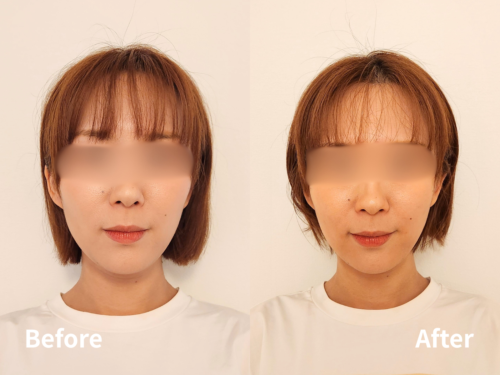 小顔矯正before＆after