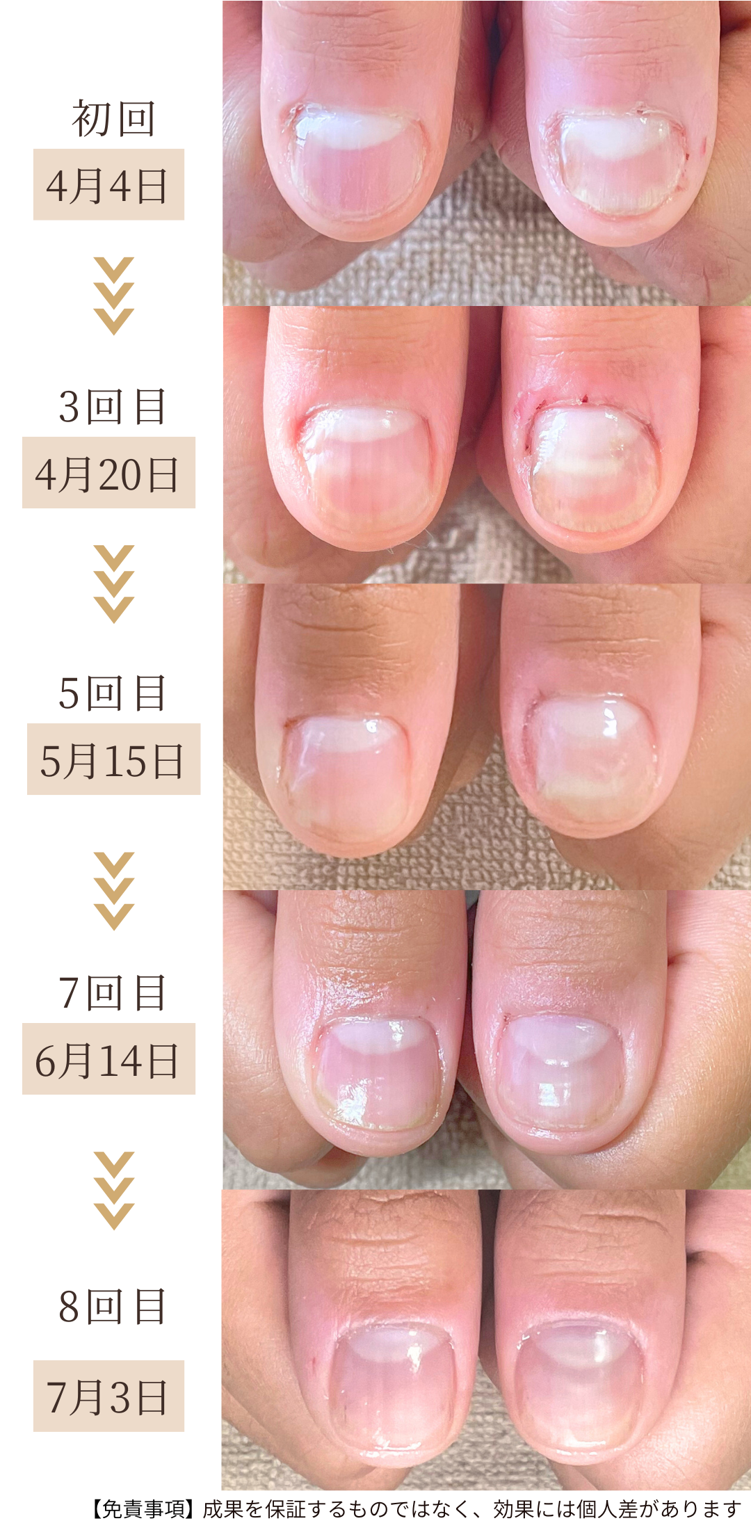 自爪育成３ヶ月の育成経過症例写真