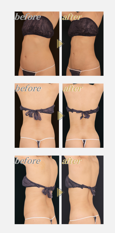 ウエスト施術前後の症例写真
