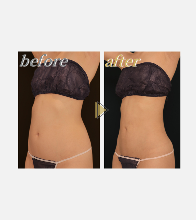 ウエスト施術前後の写真２