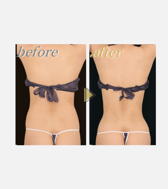 ウエスト施術前後の写真１