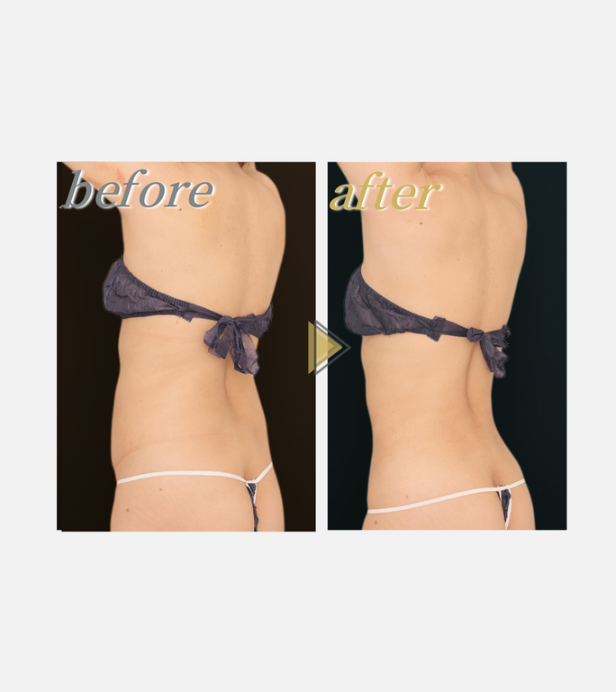 ウエスト施術前後の症例写真３