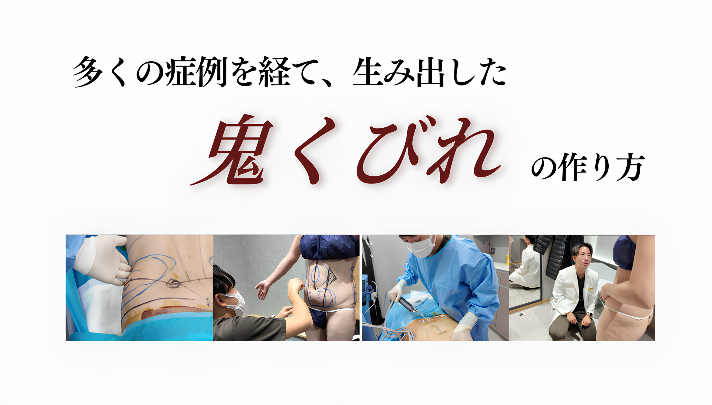 多くの症例を経て生み出した鬼くびれの作り方