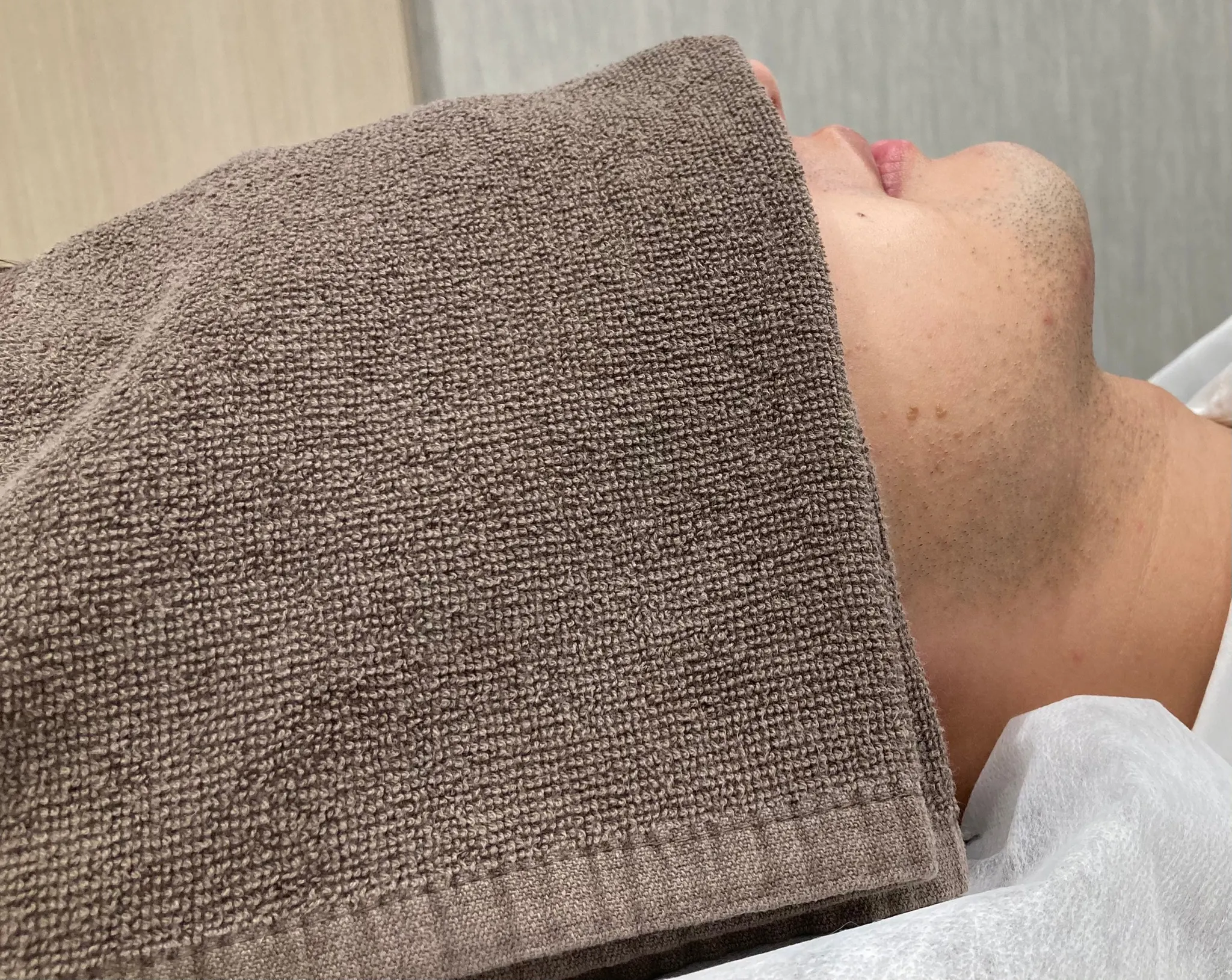 鳥取倉吉のメンズ・レディース脱毛　ヒゲ脱毛初期段階