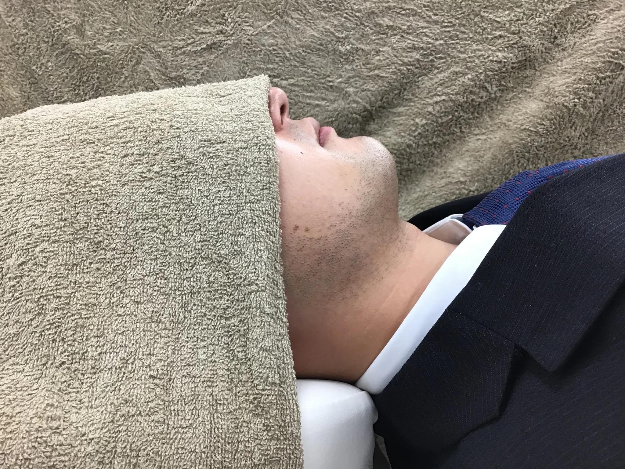 鳥取倉吉のメンズ・レディース脱毛　ヒゲ脱毛ビフォアー画像