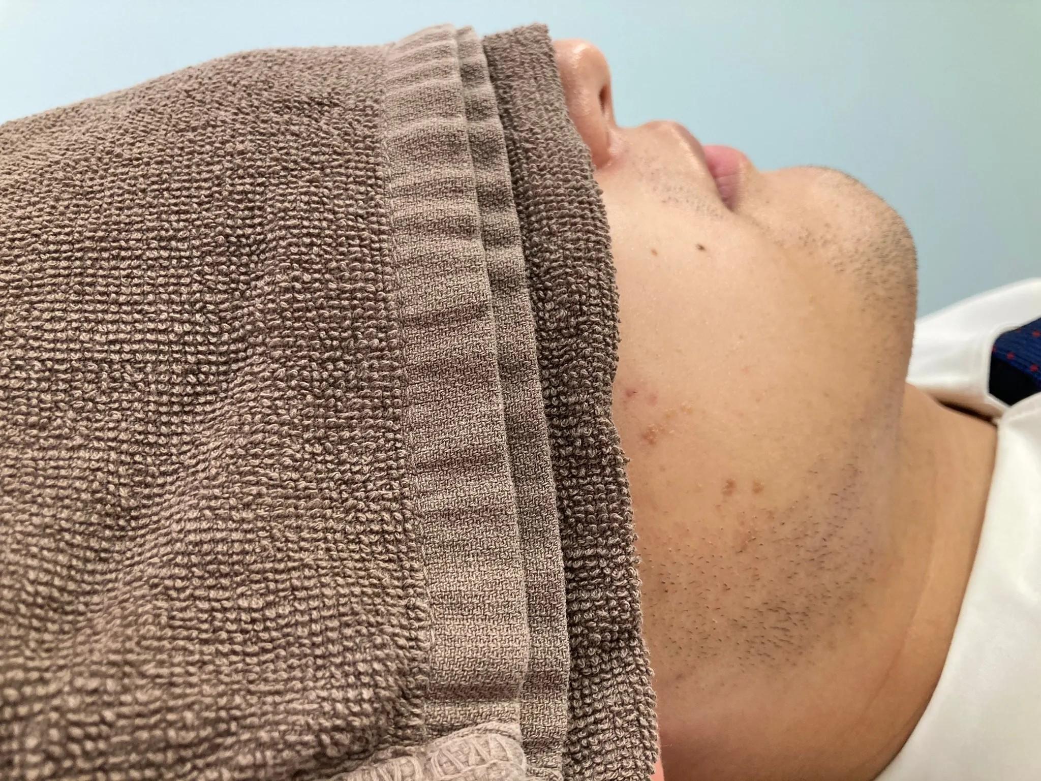 鳥取倉吉のメンズ・レディース脱毛　ヒゲ脱毛中期段階