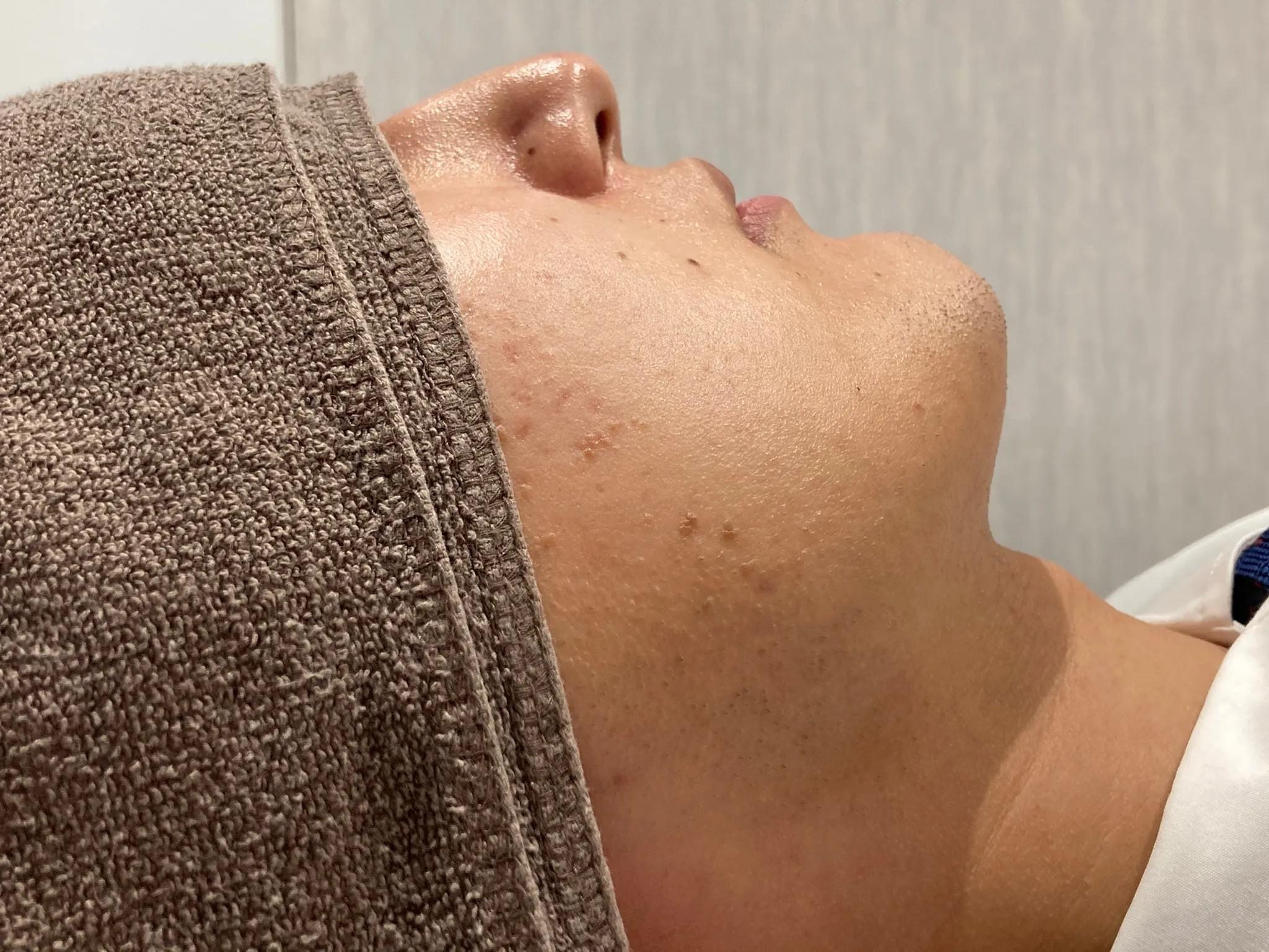 鳥取倉吉のメンズ・レディース脱毛　ヒゲ脱毛後期段階