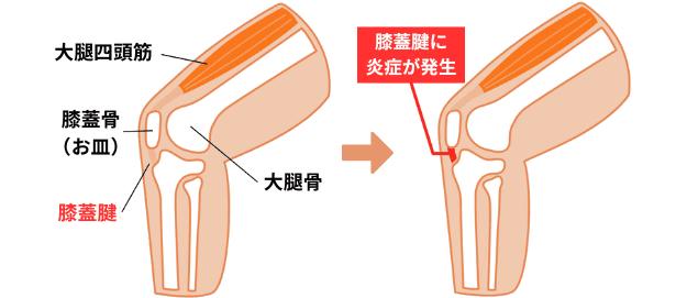 膝蓋腱炎の図解