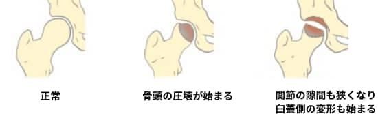 大腿骨頭壊死の図解