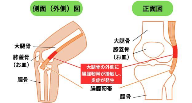 腸脛靭帯炎の図解