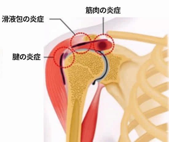 四十肩・五十肩の図解