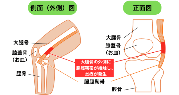 腸脛靭帯炎の図解
