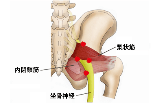 梨状筋症候群の図解