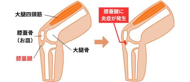 膝蓋腱炎の図解