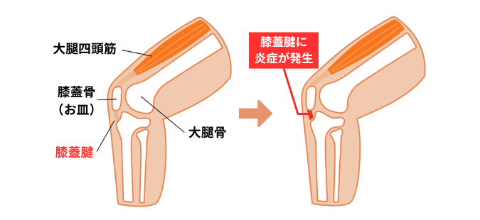 膝蓋腱炎の図解