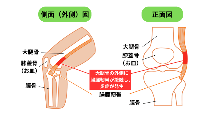 腸脛靭帯炎の図解