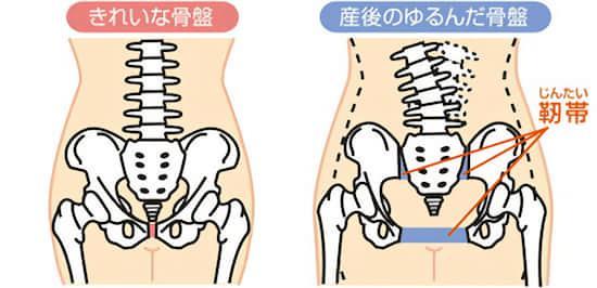 産後のゆがんだ骨盤のイラスト