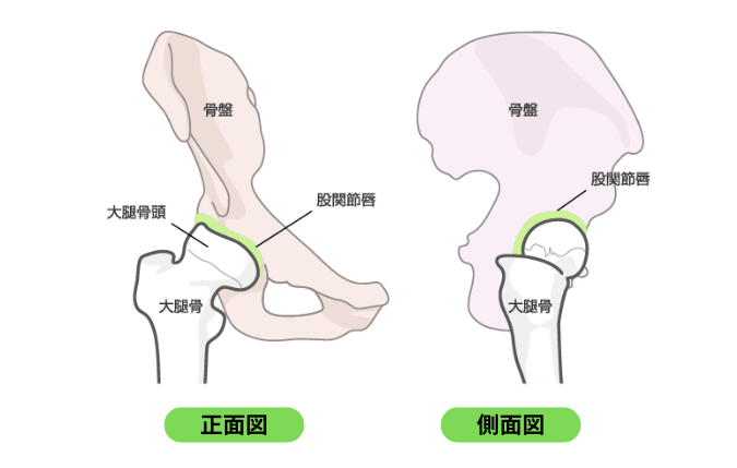 股関節唇損傷の図解