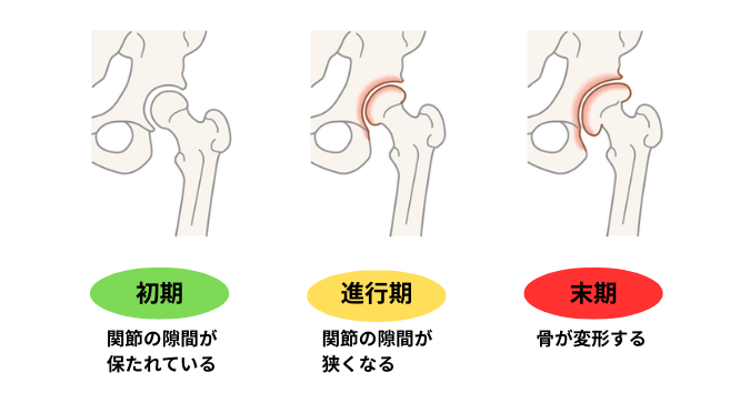 変形性股関節症の図解