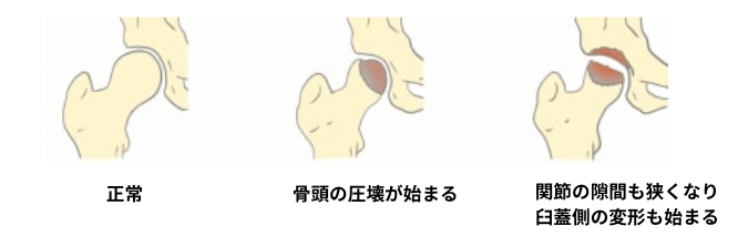 大腿骨頭壊死の図解