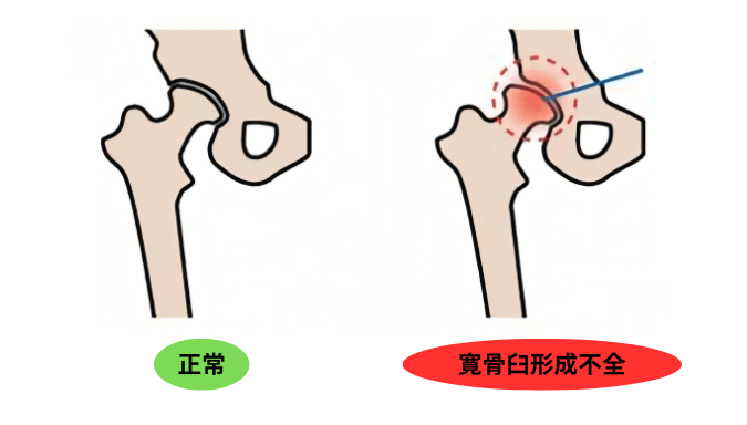 寛骨臼形成不全の図解