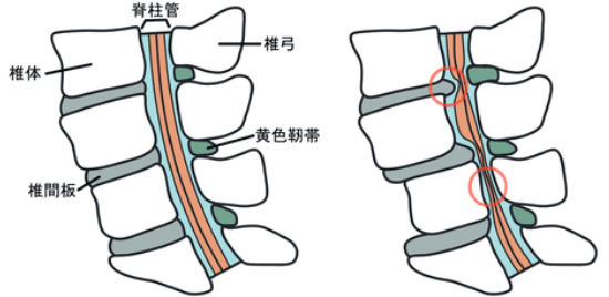 脊柱管狭窄症の図解