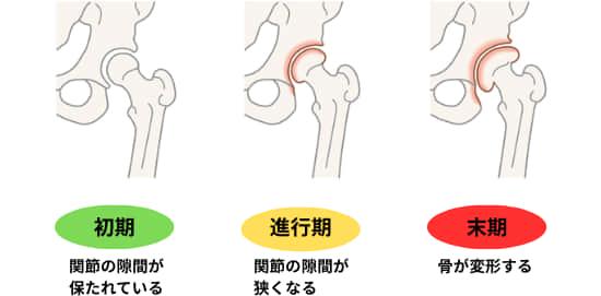 変形性股関節症の図解