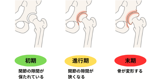 変形性股関節症の図解