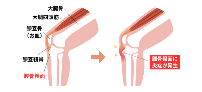 オスグッド・シュラッター病の図解