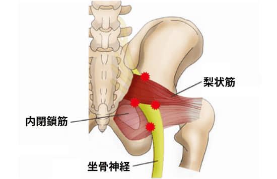 梨状筋症候群の図解