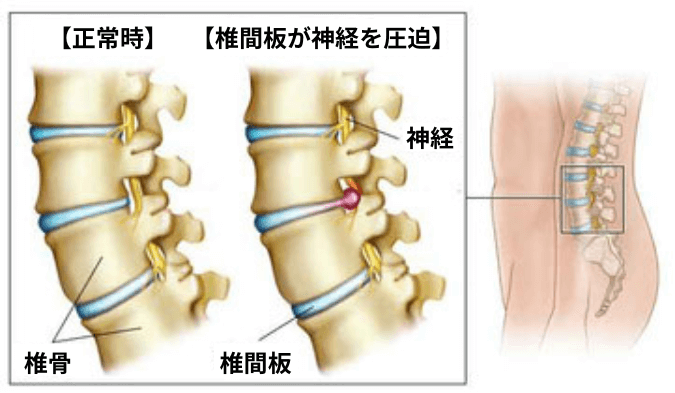 腰椎椎間板ヘルニアの図解