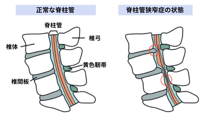 脊柱管狭窄症の図解