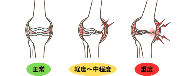 変形性膝関節症の図解