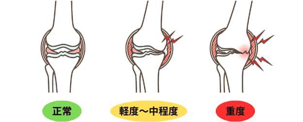 変形性膝関節症の図解