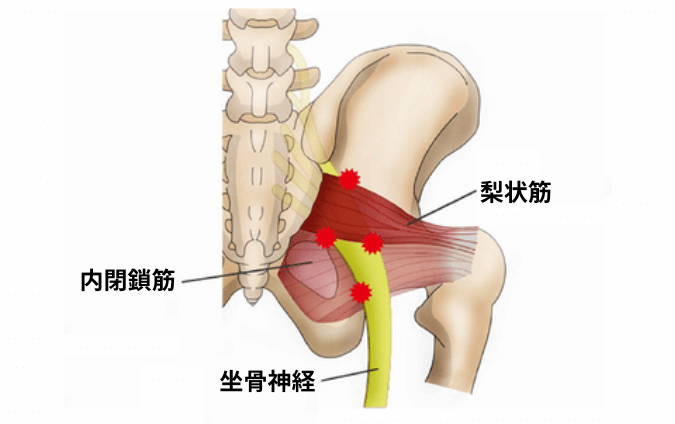 梨状筋症候群の図解